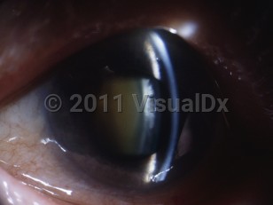 Ophthalmic Imaging image of Acute angle-closure glaucoma - imageId=5318399. Click to open in gallery. 