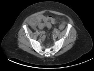 Imaging Studies image of Neutropenic enterocolitis - imageId=6110975. Click to open in gallery. 