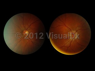 Ophthalmic Imaging image of Optic neuritis - imageId=6193472. Click to open in gallery. 