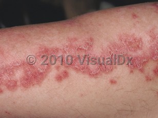 Clinical image of Subacute cutaneous lupus erythematosus - imageId=62678. Click to open in gallery.  caption: 'A close-up of annular and arcuate, scaly, erythematous plaques and nearby similar papules.'