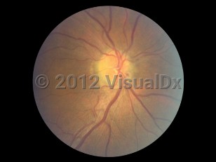 Ophthalmic Imaging image of Anterior ischemic optic neuropathy - imageId=6554314. Click to open in gallery. 