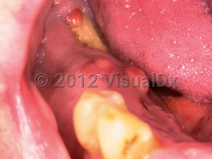 Clinical image of Bisphosphonate-related osteonecrosis of the jaw - imageId=6562751. Click to open in gallery.  caption: 'A dull yellow mass (necrotic bone) at the alveolar ridge and some surrounding yellow-pink papules.'