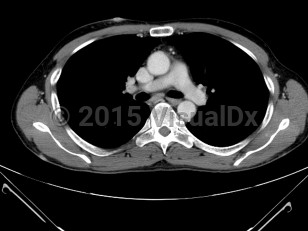 Imaging Studies image of Human herpesvirus 8 - imageId=6838428. Click to open in gallery.  caption: '<span>Single axial CT image  demonstrates a soft tissue nodule in the right anterior chest,  consistent with metastatic disease in this patient with Kaposi Sarcoma.</span>'