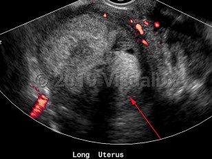 Imaging Studies image of Endometrial carcinoma - imageId=6841123. Click to open in gallery.  caption: '<span>Sagittal color Doppler image of uterus with complex mass, with no internal vascularity, path proven endometrial sarcoma.<br /></span>'