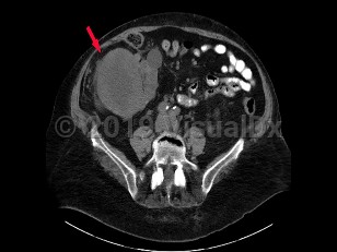 Imaging Studies image of Renal cell carcinoma - imageId=6841343. Click to open in gallery.  caption: '<span>Unenhanced axial CT scan of the abdomen and pelvis with solid mass at the lower pole in right kidney, consistent with renal cell carcinoma.</span>'