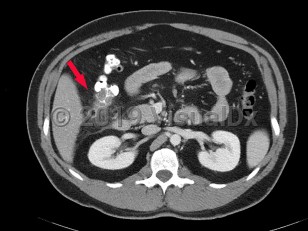 Imaging Studies image of Diverticular disease - imageId=6841976. Click to open in gallery.  caption: '<span>Axial image from CT scan of  abdomen and pelvis with wall thickening of ascending colon, with an  inflamed diverticulum consistent with diverticulitis.</span><br />'