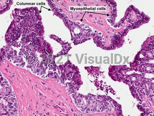 Lab image of Hidradenoma papilliferum - imageId=7159613. Click to open in gallery. 