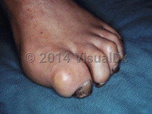 Clinical image of Charcot-Marie-Tooth disease - imageId=7298164. Click to open in gallery.  caption: 'Hammer toes and unrelated dystrophic nail changes of onychomycosis.'