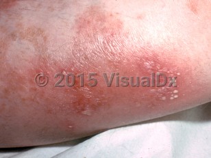 Clinical image of Impetigo herpetiformis - imageId=7372956. Click to open in gallery. 