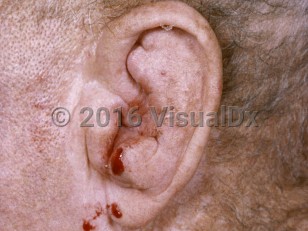 Clinical image of Perichondritis - imageId=7407461. Click to open in gallery.  caption: 'Marked swelling and deformity of the cartilage of the ear.'