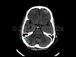 Imaging Studies image of Cerebellar contusion - imageId=7872512. Click to open in gallery.  caption: '<span>Axial CT image demonstrates a  focal hyperdensity in the right cerebellum with surrounding edema in  this patient with history of trauma. Findings were consistent with  cerebellar contusion.</span>'