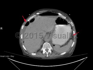 Imaging Studies image of Bowel perforation - imageId=7877196. Click to open in gallery.  caption: '<span>Axial CT image demonstrates  numerous foci of free intraperitoneal air secondary to a large bowel  perforation (found intraoperatively)</span>.'