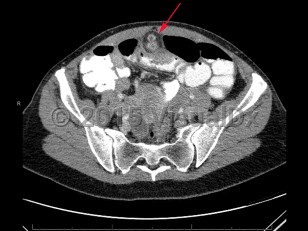 Imaging Studies image of Meckel diverticulum - imageId=7879679. Click to open in gallery.  caption: '<span>CT scan of abdomen and pelvis  demonstrating enhancing nodular focus extending from ileum, which was  path proven Meckel diverticulitis.</span>'