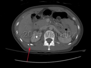 Imaging Studies image of Rib fracture - imageId=7885255. Click to open in gallery.  caption: '<span>CT scan of the chest in bone windows demonstrating fractures of the right 11th and 12th ribs.</span>'