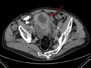 Imaging Studies image of Bladder cancer - imageId=7885454. Click to open in gallery.  caption: '<span>Axial image from an enhanced CT scan of the pelvis  demonstrating marked irregular wall thickening of the bladder.</span>'