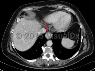 Imaging Studies image of Esophageal carcinoma - imageId=7885731. Click to open in gallery.  caption: '<span>Axial image from a CT scan demonstrating wall thickening of distal esophagus in biopsy proven esophageal cancer.</span>'