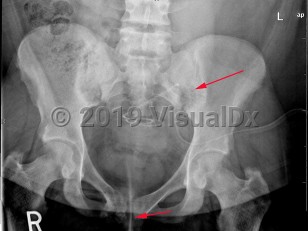 Imaging Studies image of Primary hyperparathyroidism - imageId=7902630. Click to open in gallery.  caption: '<span>Subchondral/subligamentous  bone resorption at the sacroiliac joints and pubic symphysis, compatible  with hyperparathyroidism. Note the presence of a peritoneal dialysis  catheter.</span>'