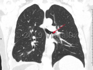 Imaging Studies image of Bronchial carcinoid tumor - imageId=7903592. Click to open in gallery.  caption: '<span>Coronal CT image demonstrates a  soft tissue density nodule within the left mainstem bronchus.  Bronchoscopic biopsy was consistent with endobronchial carcinoid.</span>'