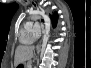 Imaging Studies image of Coarctation of the aorta - imageId=7903687. Click to open in gallery.  caption: '<span>CT image demonstrates focal  narrowing of the aorta just distal to the origin of the left subclavian  artery in this patient with known aortic coarctation.</span>'