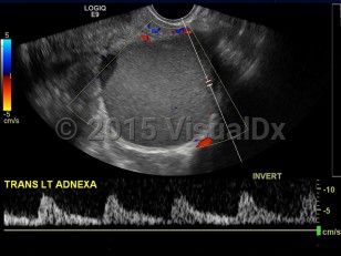 Imaging Studies image of Endometriosis - imageId=7903947. Click to open in gallery.  caption: '<span>Ultrasound image  demonstrates left ovarian unilocular cyst with diffuse low level echoes  and through transmissions. In this patient with known endometriosis,  findings consistent with endometrioma.</span>'