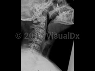 Imaging Studies image of Epiglottitis - imageId=7904171. Click to open in gallery.  caption: '<span>Lateral cervical radiograph demonstrates thickening and irregularity of the epiglottis consistent with epiglottitis.</span>'