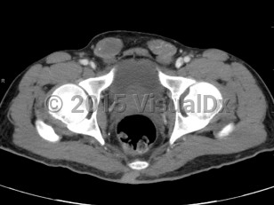 Imaging Studies image of Cryptorchidism - imageId=7904911. Click to open in gallery.  caption: '<span>Axial CT image demonstrates  bilateral extrascrotal testes, located in the inguinal canal. Findings  consistent with cryptorchidism.</span>'