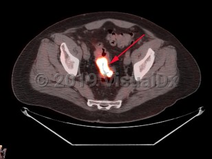 Imaging Studies image of Rectal carcinoma - imageId=7911680. Click to open in gallery.  caption: 'Fused image from PET/CT scan of the pelvis demonstrating hypermetabolic wall thickening of the rectosigmoid, corresponding to path proven cancer.'