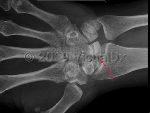 Imaging Studies image of Avascular necrosis - imageId=7924537. Click to open in gallery.  caption: '<span>Sclerosis and mild fragmentation of the lunate, compatible with Kienböck disease (avascular necrosis of the lunate).</span>'