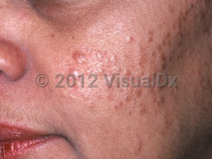 Clinical image of Osteoma cutis - imageId=812096. Click to open in gallery.  caption: 'Numerous shiny light brown papules on the cheek.'