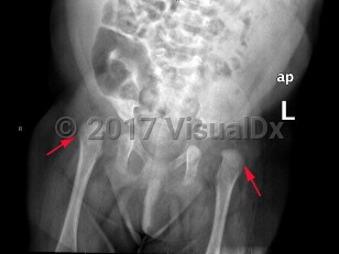 Imaging Studies image of Developmental dysplasia of the hip - imageId=8334771. Click to open in gallery.  caption: '<span>Bilateral dislocation of the  hips, with the hips oriented lateral and superior to the acetabula. The  acetabula are dysplastic bilaterally. These are imaging findings of  bilateral congenital hip dislocation.</span>'