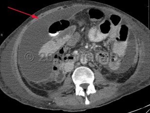 Imaging Studies image of Peritonitis - imageId=8341512. Click to open in gallery.  caption: '<span>Enhanced axial CT scan of the abdomen and pelvis demonstrates large amount of loculated peritoneal fluid with enhancing rim in the abdomen and pelvis.</span>'