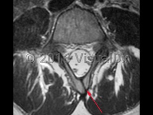 Imaging Studies image of Spina bifida - imageId=8343872. Click to open in gallery.  caption: '<span>Axial MRI demonstrating bony defect in vertebral arch.</span>'