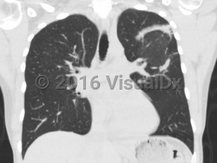 Imaging Studies image of Cryptogenic organizing pneumonia - imageId=8350008. Click to open in gallery.  caption: '<span>Reverse halo/atoll sign within  the right upper lobe and superior segment of the right lower lobe, with  peripheral dense airspace and central areas of ground glass  attenuation. Some additional areas of ground glass and airspace  opacities, and patchy airspace disease with the right middle lobe, with  traction bronchiectasis and architectural distortion.</span>'