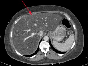 Imaging Studies image of Metabolic dysfunction-associated steatotic liver disease - imageId=8358603. Click to open in gallery.  caption: '<span>Axial image from contrast enhanced CT scan of the abdomen demonstrating marked low attenuation of the liver, consistent with hepatic steatosis.</span>'