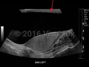 Imaging Studies image of Hydrocele of testis - imageId=8358988. Click to open in gallery.  caption: '<span>Grayscale ultrasound image of the scrotum demonstrates a large hydrocele with debris on the left.</span>'