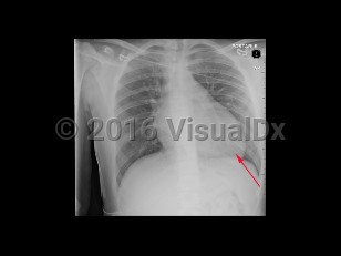 Imaging Studies image of Hypertrophic cardiomyopathy - imageId=8359232. Click to open in gallery.  caption: '<span>AP view of the chest demonstrating an enlarged heart in this patient with diagnosed hypertrophic cardiomyopathy.</span>'