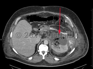 Imaging Studies image of Perinephric abscess - imageId=8360654. Click to open in gallery.  caption: '<span>Axial image from enhanced CT scan of the abdomen and pelvis with a complex left perirenal fluid collection with air, consistent with a perinephric abscess.</span>'