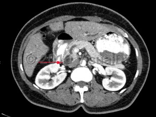 Imaging Studies image of Carcinoma of the ampulla of Vater - imageId=8367516. Click to open in gallery.  caption: '<span>Contrast enhanced CT scan of abdomen and pelvis demonstrates ampullary carcinoma with duct dilatation.</span>'