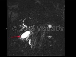 Imaging Studies image of Cholangiocarcinoma - imageId=8368519. Click to open in gallery.  caption: '<span>MCRP demonstrates peripheral and central enhancement consistent with cholangiocarcinoma.</span>'