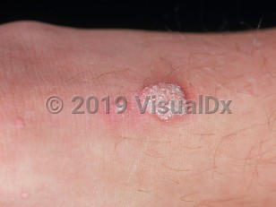 File:Scars of yaws lesions on the legs of a female patient with a