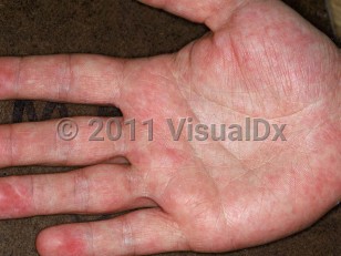maculopapular rash hands