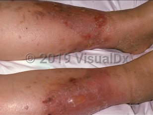 Derm Dx: White spots on the legs - Clinical Advisor