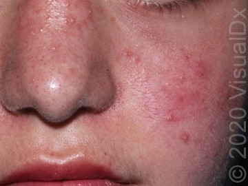 Acne Vulgaris: A Guide to Diagnosis, Treatment, and Management | VisualDx