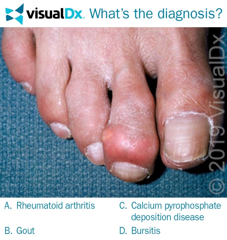 man-s-toe-has-painful-smooth-nodule-on-the-joint-let-s-diagnose