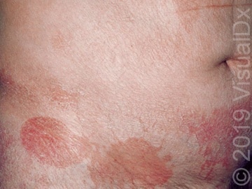 Patient Believes Detergent Caused Rash, Derm PA-C Uses VisualDx to ...