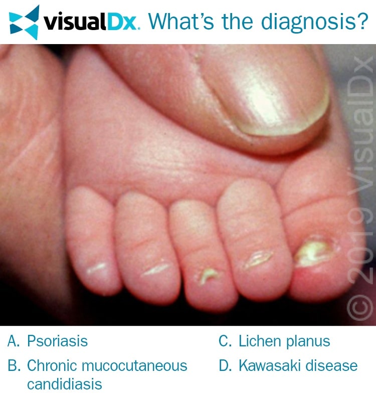 10-Month-Old Returns to Doctor with Nail Infection, Diaper Rash - Let’s ...