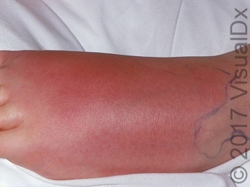 Cellulitis and its Mimickers