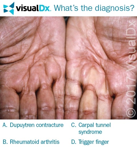 Man Has Pain, Numbness, Trouble Opening His Hand - Let’s Diagnose ...