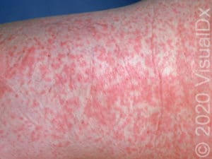 Dermatologic Findings in COVID-19: A Review of the Literature | VisualDx