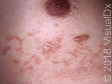 Schistosomiasis Rash